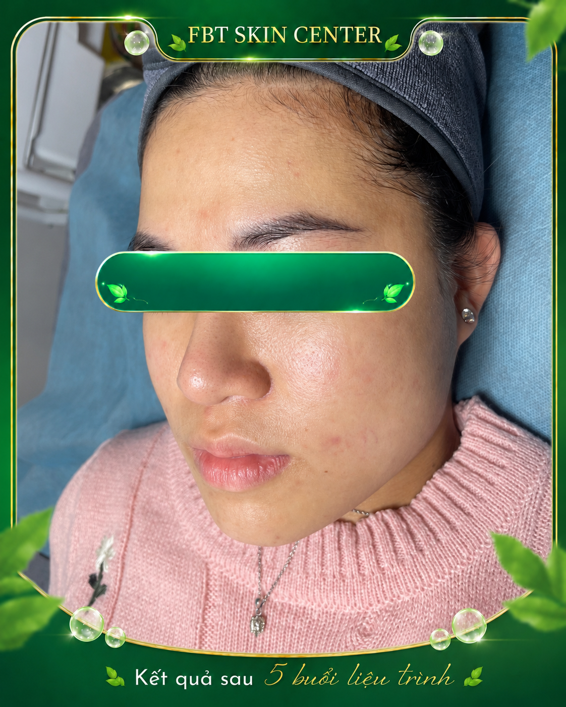 Kết quả da giảm mụn sau 5 buổi liệu trình tại FBT Skin Center