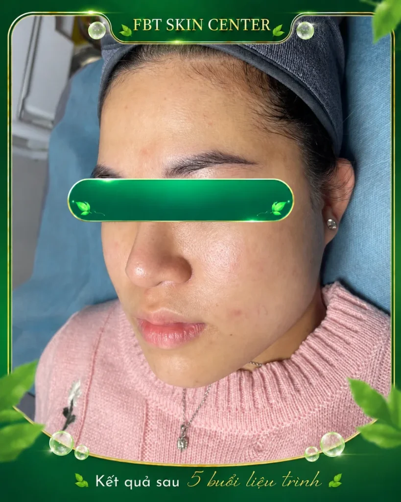Kết quả da giảm mụn sau 5 buổi liệu trình tại FBT Skin Center