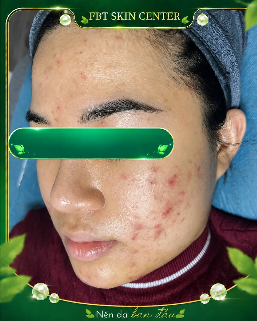 Nền da ban đầu có mụn viêm và thâm mụn trước khi chăm sóc tại FBT Skin Center